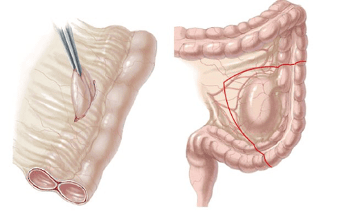 
Bệnh ruột đôi hình thành trong quá trình hình thành ống tiêu hóa khi đường tiêu hóa bị lặp lại
