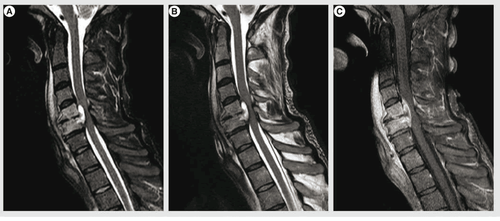 Extramembranous abscess easily causes disability