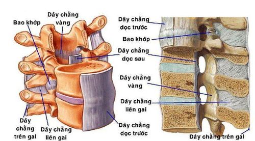 Hẹp ống sống do dây chằng vàng