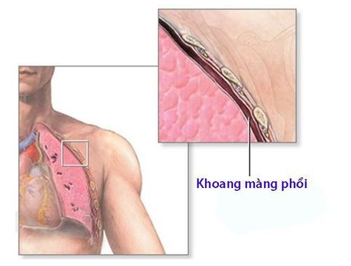 Pleurisy surgery to treat deposits and thickening of the pleura