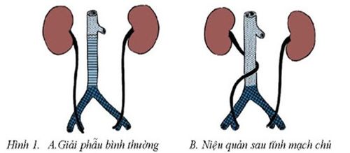 Tìm hiểu về bệnh niệu quản sau tĩnh mạch chủ