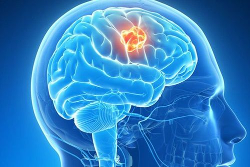 What is craniopharyngioma and is it dangerous?