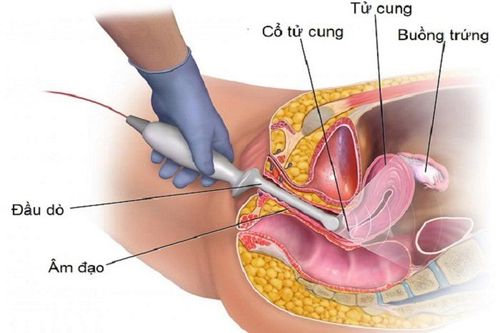 
Hình ảnh mô tả kỹ thuật siêu âm qua đường âm đạo
