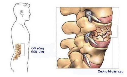 Phẫu thuật dị tật đốt sống chẻ đôi bằng đường vào phía sau