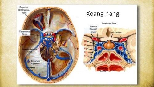 
Trường hợp dị dạng động - tĩnh mạch màng cứng xuất hiện ở động mạch cảnh trong - xoang hang
