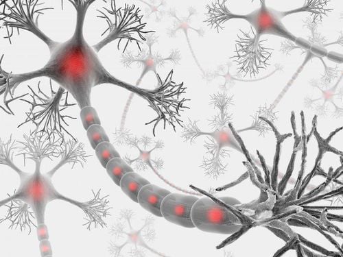 Demyelinating peripheral neuropathy due to paraproteinemia