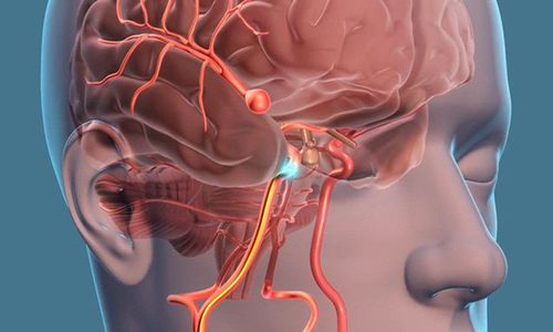 Microsurgical procedure for clamping brain aneurysms