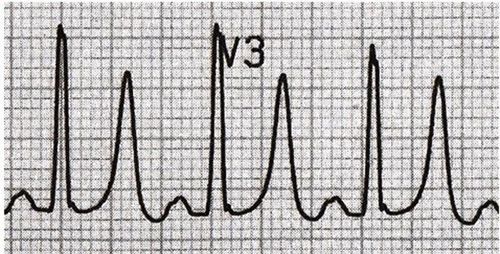 
Kali trong máu tăng cao khiến QRS dài
