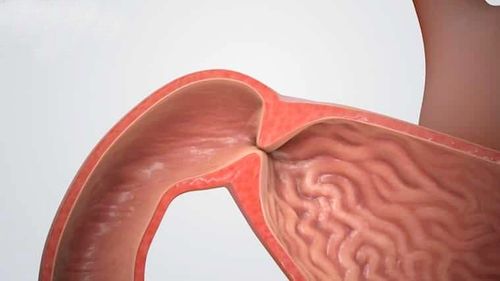 Can pyloric stenosis with chronic obstructive pulmonary disease be laparoscopic?