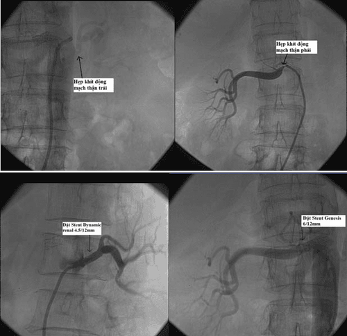 Renal artery MRI: What you need to know