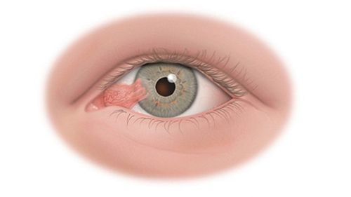 Eye conjunctival tumor: What you need to know