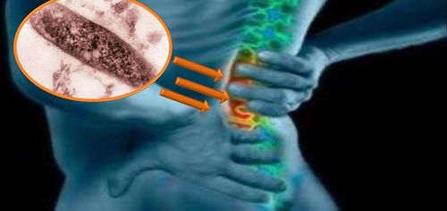 X-ray image of spinal tuberculosis