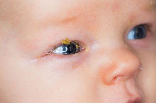 There are many causes of tearing in newborns.
