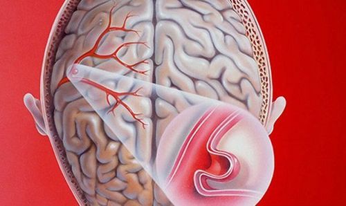 Cerebral aneurysm rupture: Dangerous complications