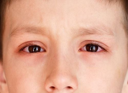 Trẻ bị đau mắt, sưng tấy mi dưới, mắt xuất huyết trong có đáng lo?