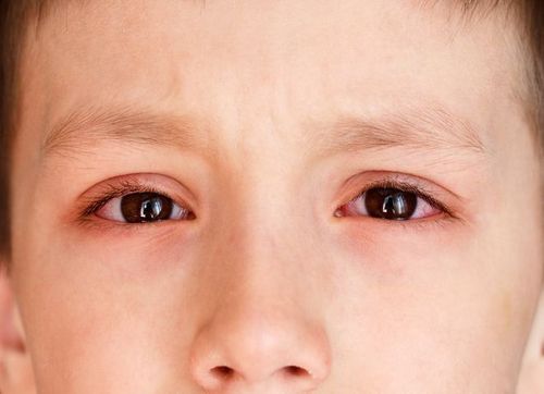 Lupus ảnh hưởng đến mắt như thế nào?