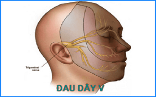 Tai biến thường gặp khi mổ nội soi hỗ trợ điều trị đau dây thần kinh số V