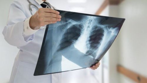 X-rays help diagnose Candida in the lungs