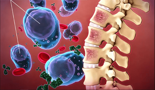 Treatment of multiple myeloma with stem cells