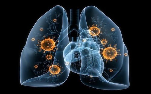 Computed tomography of the lungs: What you need to know