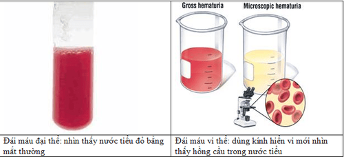 
hình ảnh phân biệt đái máu đại thể và đái máu vi thể
