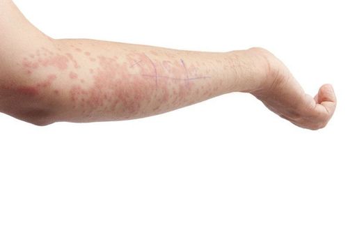 Mối liên hệ giữa bệnh lupus và viêm mạch máu