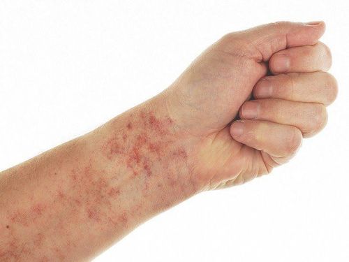 Nguyên nhân tăng men gan của người nhiễm sốt xuất huyết Dengue