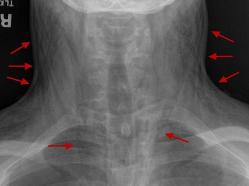 What is subcutaneous emphysema?