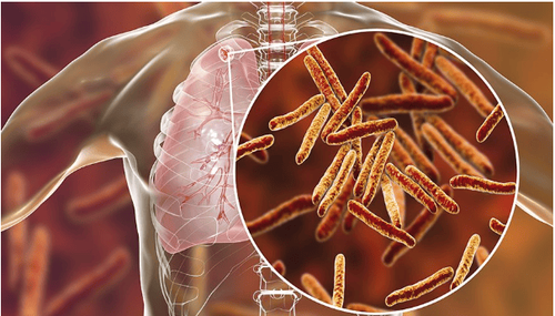 Tuberculosis, tuberculosis abscess, tuberculous radiculopathy