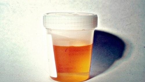 Is red urine after endoscopy for kidney stones?