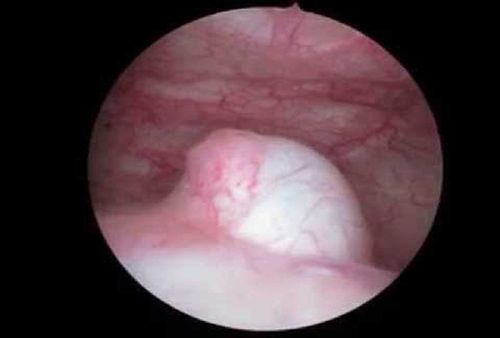 What is ureteral prolapse?