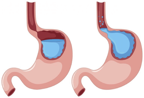 How to distinguish cough caused by pneumonia and caused by gastroesophageal reflux?