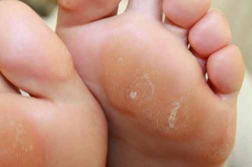 Bị chai chân lâu năm nên chọn phương pháp điều trị nào cho hiệu quả?