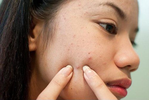 Should you pop acne?