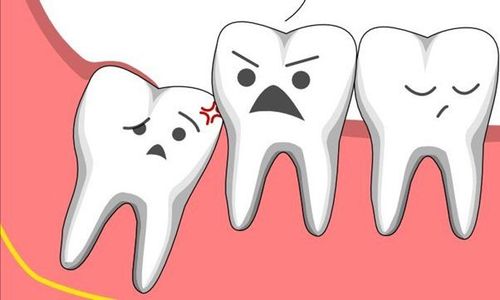 When to take a wisdom tooth x-ray?