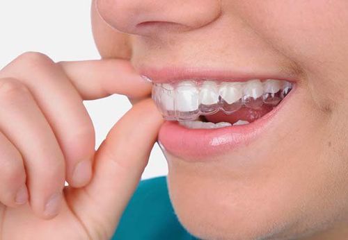 Trẻ 10 tuổi có nên dùng máng chống nghiến răng?