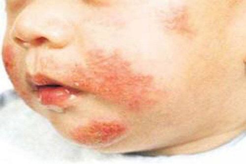 Trẻ tiêm Vắc-xin Lao về bị mẩn đỏ có sao không?
