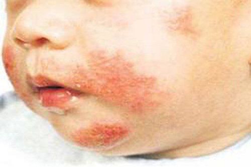 
Bệnh lupus ban đỏ có thể lây từ mẹ sang con
