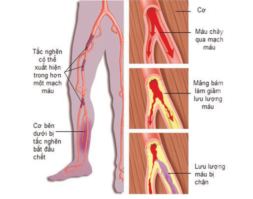 
Tắc động mạch chi thì có thể thực hiện biện pháp như tiến hành cấp cứu vết thương đứt mạch máu.
