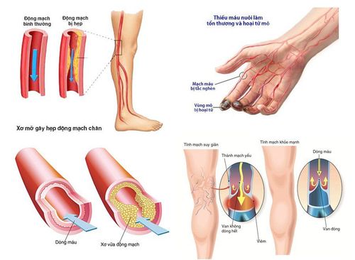 Surgical ligation of the great peripheral blood vessels