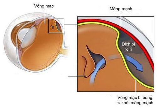 
Vết thương mạch máu có thể làm cho lớp nội mạc bị bong
