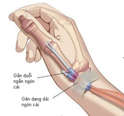 What is rotator cuff tendonitis?