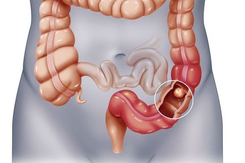 Non-catheterized computed tomography of the small intestine