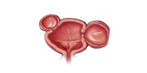 Diagnosis and treatment of bladder diverticulum