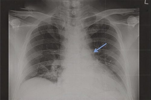 Mediastinal pneumothorax: What you need to know