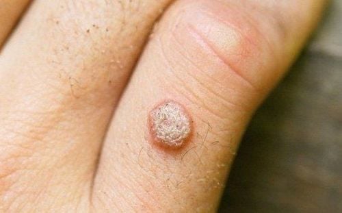 Should Salicylic Acid Treat Warts?