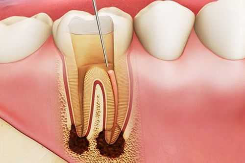 
Lấy tủy răng giúp hạn chế việc viêm nhiễm lan xuống vùng cuống răng gây nhiễm trùng cuống
