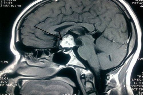 
Bệnh nhân nghi ngờ u tuyến yên cần chụp MRI
