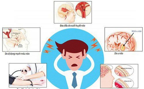 Đau nửa đầu bên phải là triệu chứng bệnh gì?