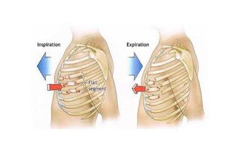 Movable rib plate due to chest trauma